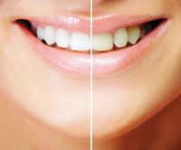 Zahnaufhellung Teeth Whitening